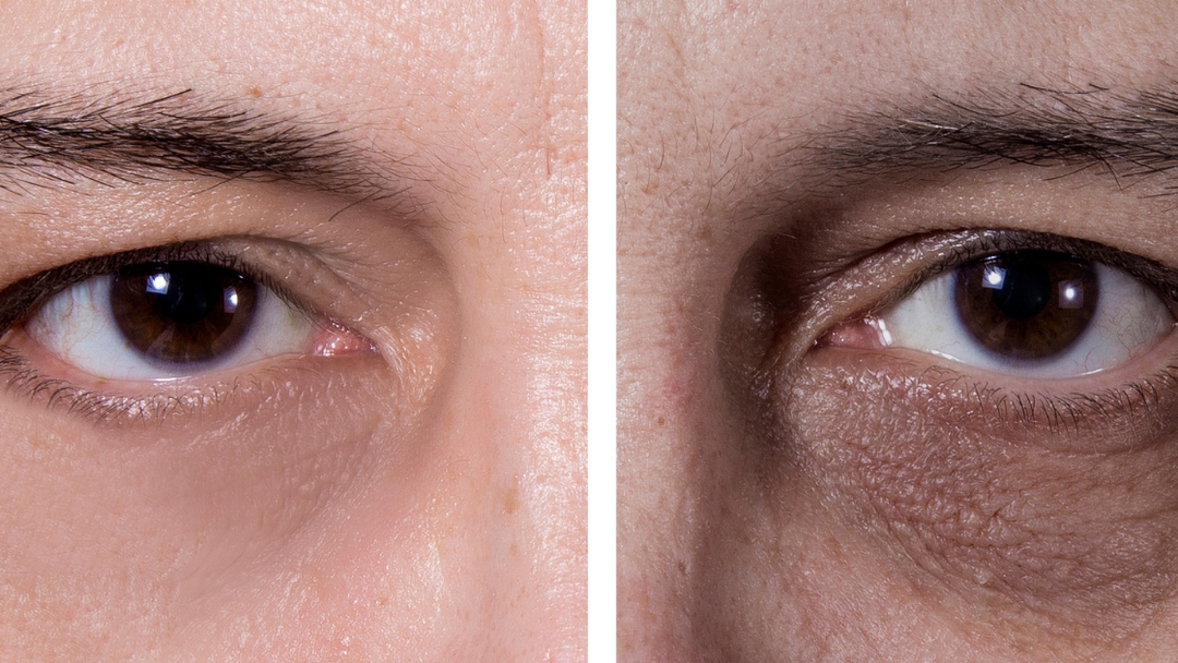 Does A Lack Of Sleep Cause Dark Circles Under Our Eyes?