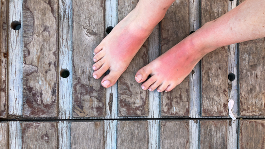 Getting a Good Night's Sleep After Sunburn