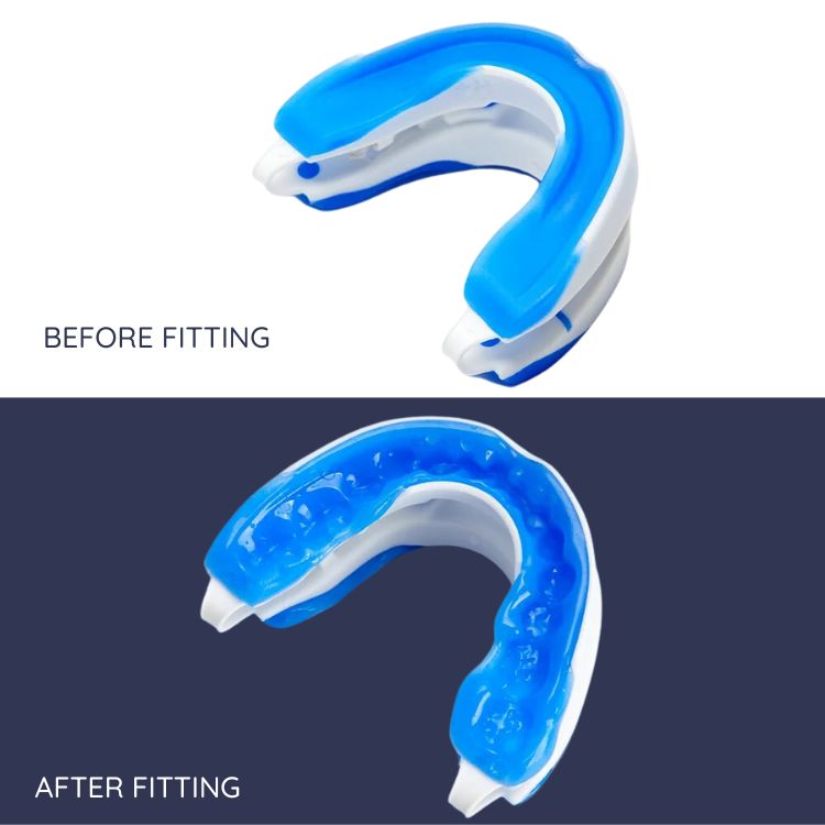 Anti Snoring Mouth Guard For Sleeping - Custom Fit